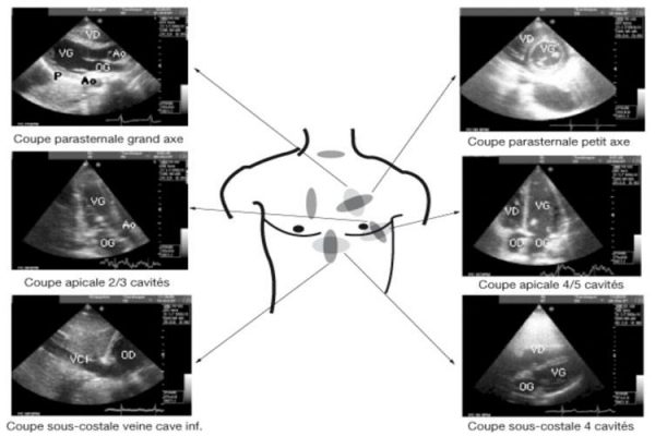 échographie cardiaque