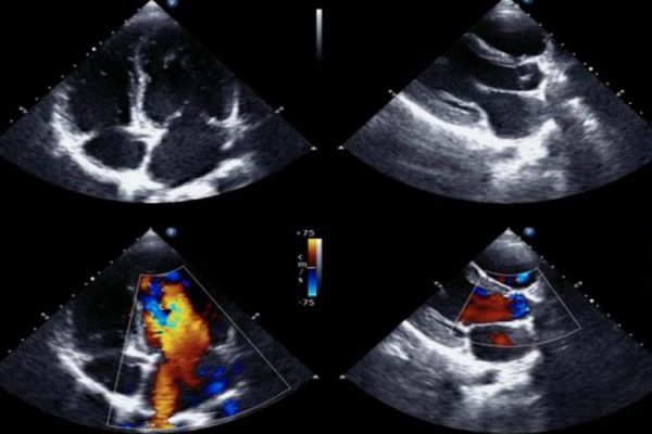 échographie cardiaque